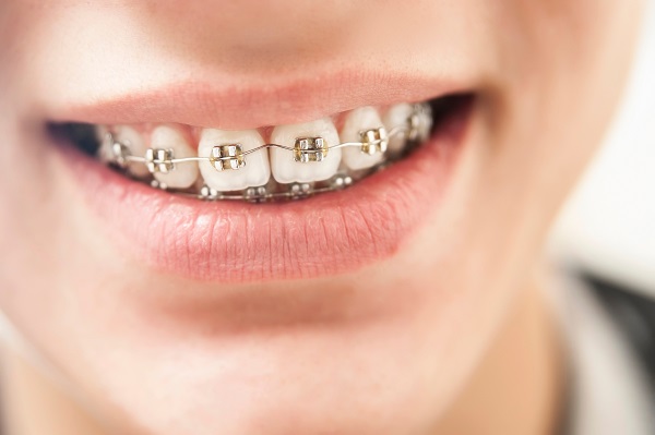 Braces Consultation